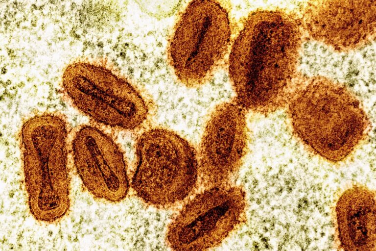 EEUU reporta primer contagio de nuevo tipo de viruela símica en viajero