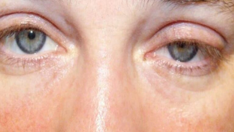 Qué es la miastenia gravis, que crece en las mujeres jóvenes y los hombres mayores de 50?