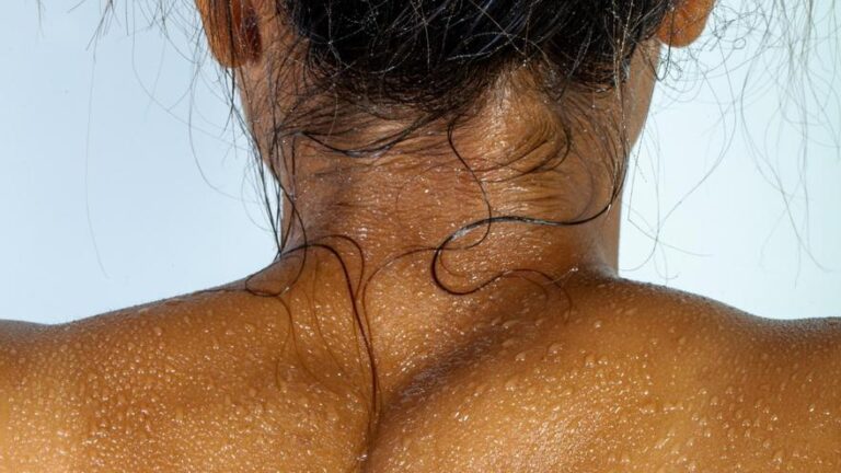 Hidradenitis supurativa: qué es y por qué se llaman bartolillos o golondrinos los granos gigantes