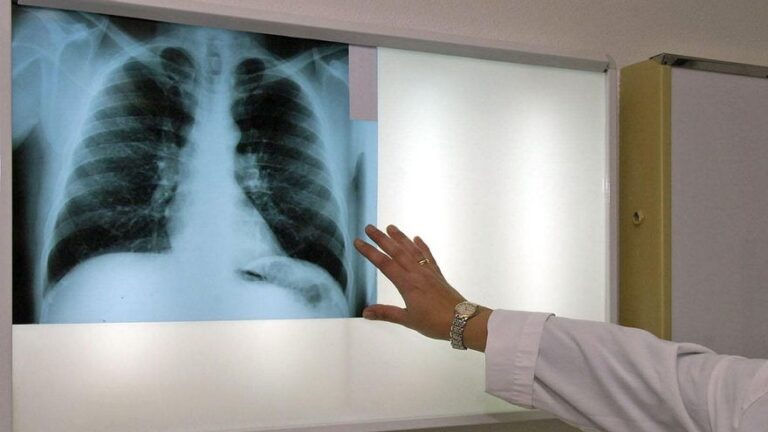 El cribado de cáncer de pulmón en España, poco conocido pero clave para salvar vidas