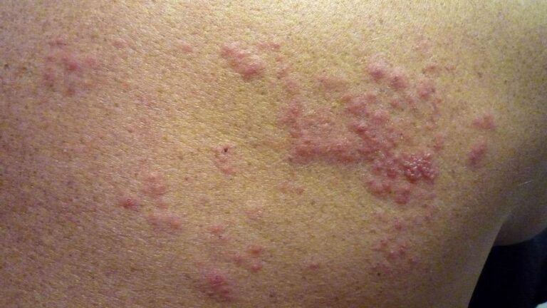 Herpes zoster: así es la enfermedad que pasará un 30% de la población a lo largo de su vida