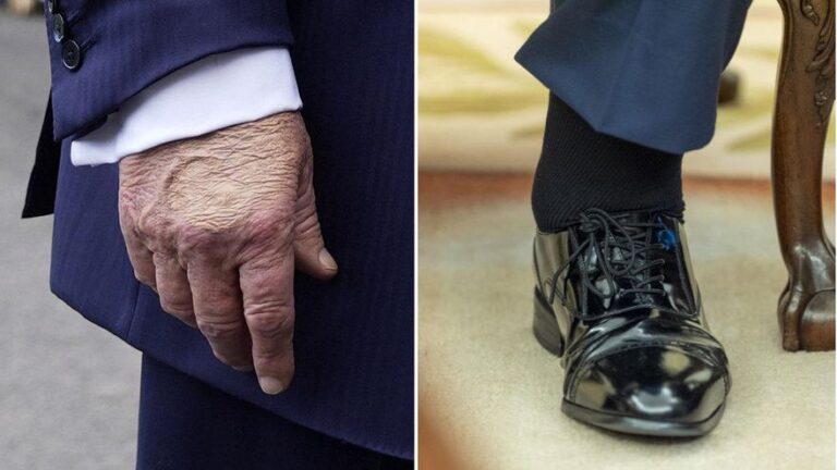 Trump sufre una insuficiencia venosa crónica que la Casa Blanca niega que sea grave