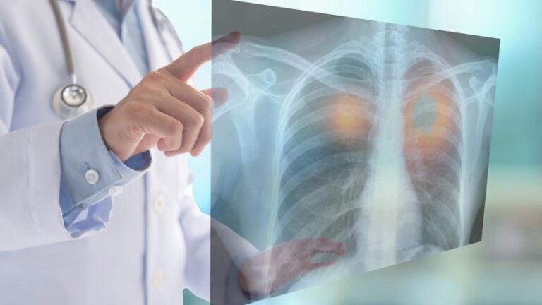 Investigadores españoles identifican una huella inmunitaria en sangre que predice la respuesta a la quimio-inmunoterapia en cáncer de pulmón